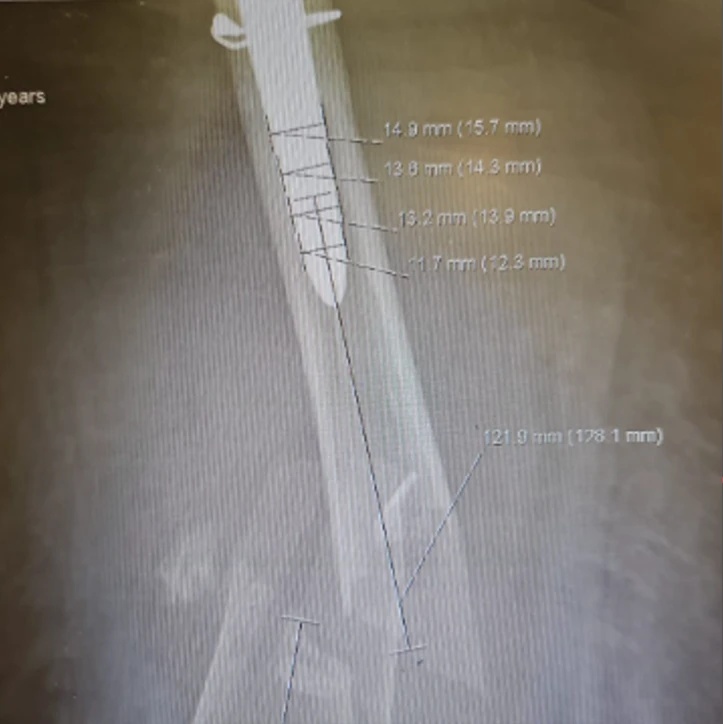Intra-operative X-ray — PeriNail™ periprosthetic hip nailing system