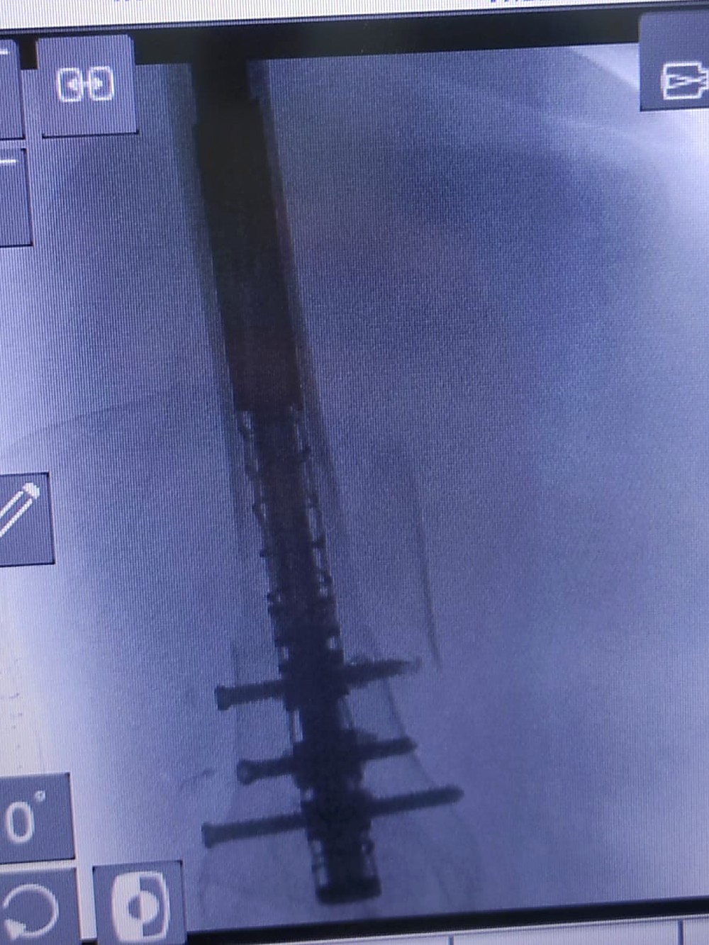 Intra-operative X-ray showing distal locking of the PeriNail implant