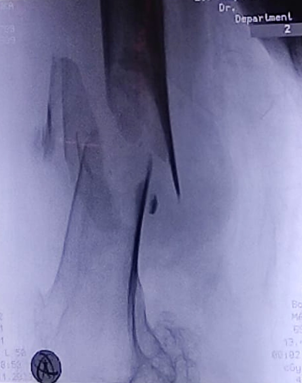 Intra-operative X-ray of the PeriNail implant placed within the femur