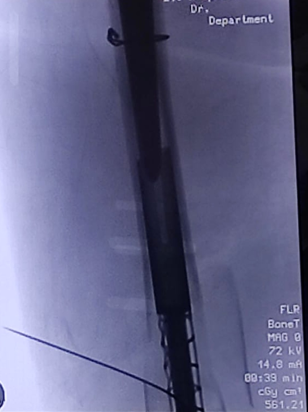 Intra-operative X-ray showing the PeriNail implant merging with the existing femoral stem
